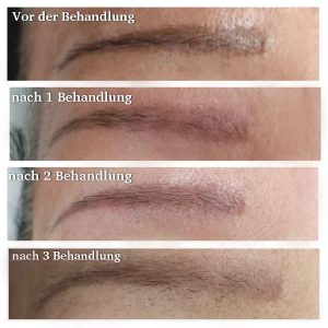 Permanent Make-Up Entfernung
